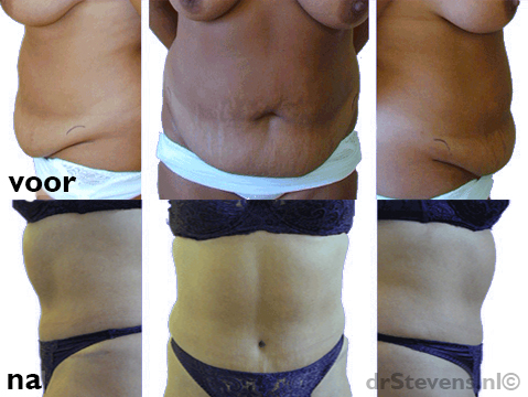 buikspieren vrouw anatomie