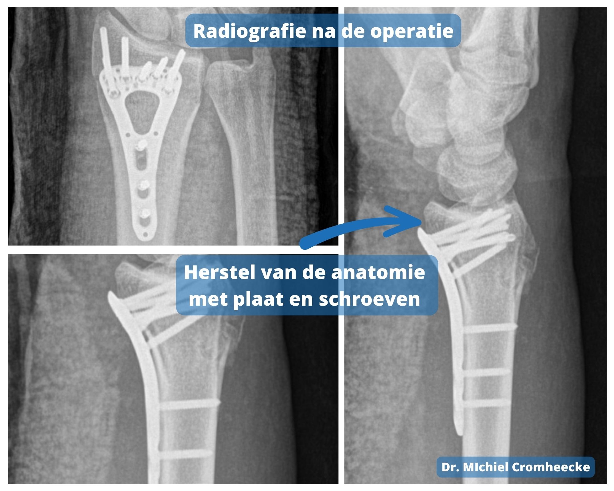 handbeentjes anatomie
