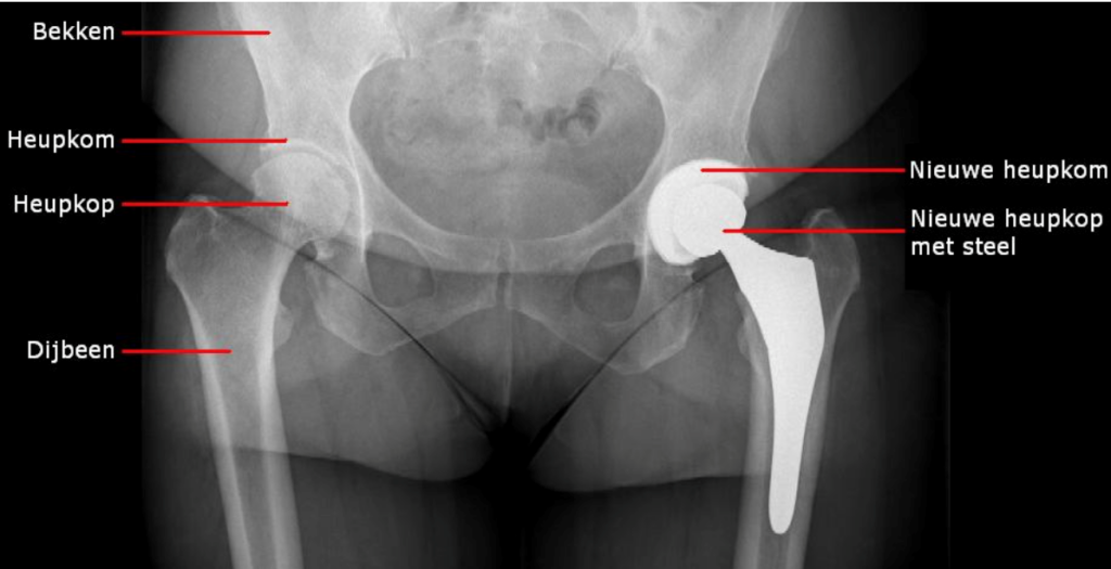 anatomie heupgewricht